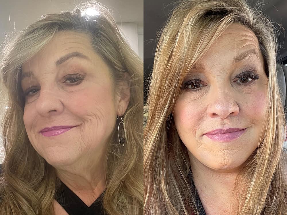 Facelift Before & After Photos: What a Facelift Looks Like at 40, 50, 60 &  70, Facelift in San Diego, CA