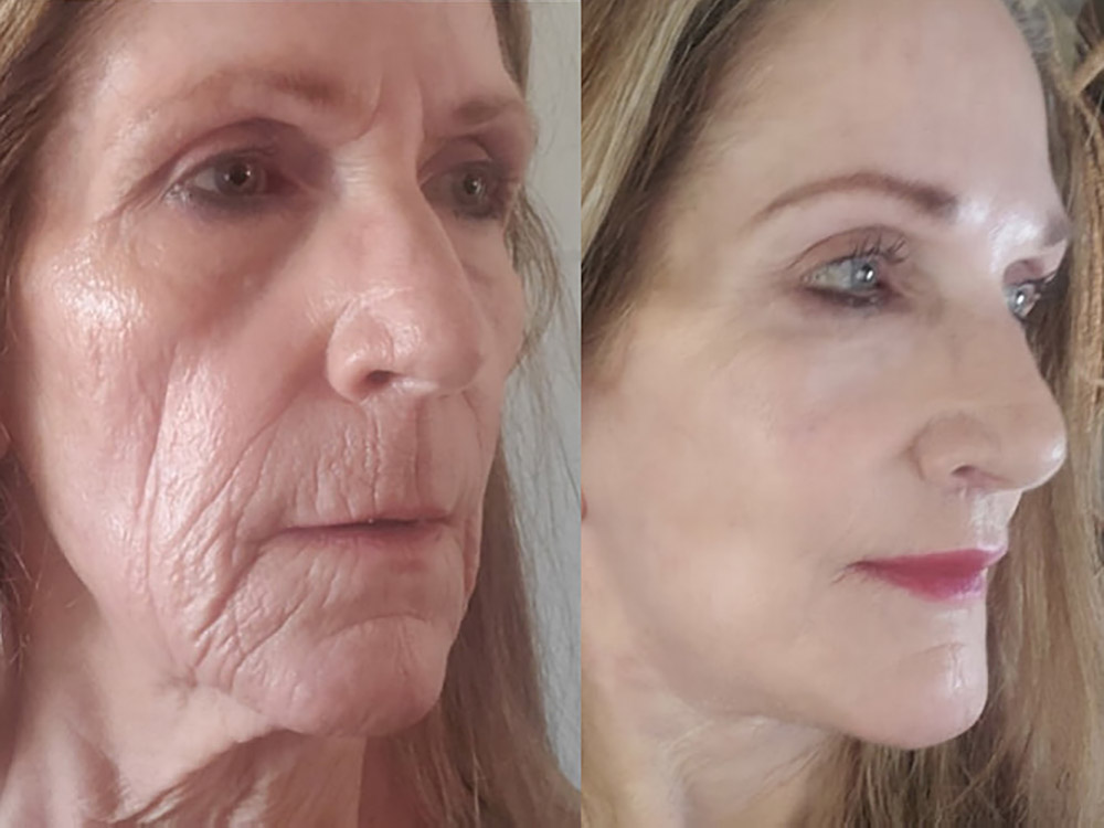 Real patient, Facelift Before and After - Malone Plastic Surgery San Diego