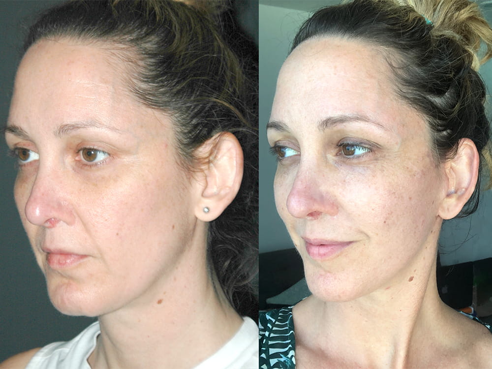 Real patient, Mini Facelift Before and After - Malone Plastic Surgery San Diego