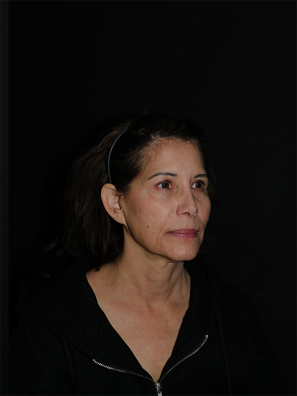 Facelift & Neck Lift Before & After Photo