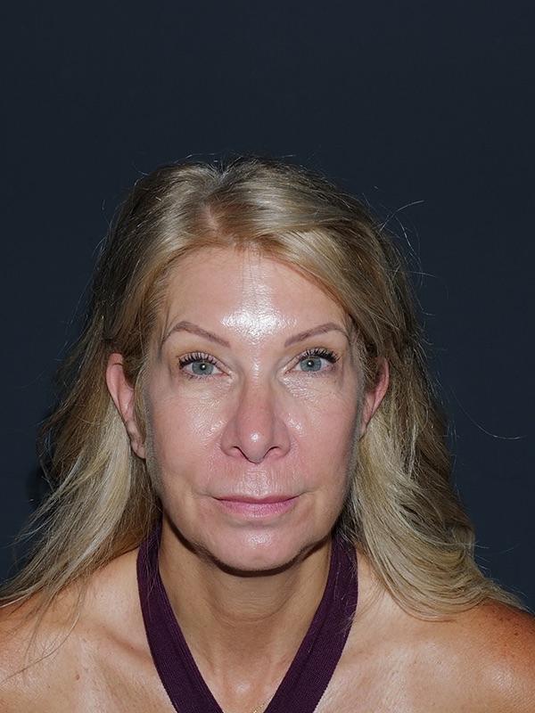 Facelift & Neck Lift Before & After Photo