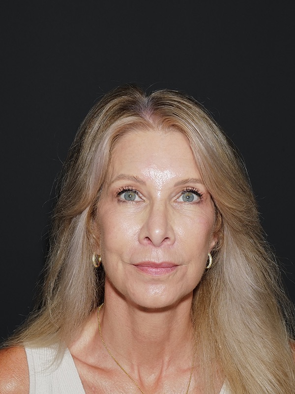 Facelift & Neck Lift Before & After Photo