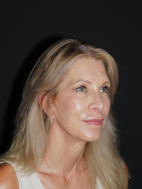 Facelift & Neck Lift Before & After Photo