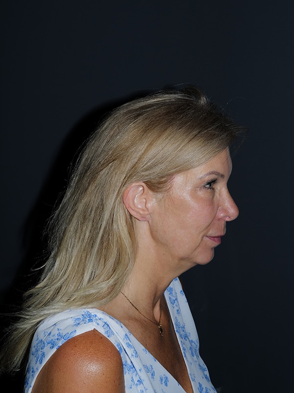 Facelift & Neck Lift Before & After Photo