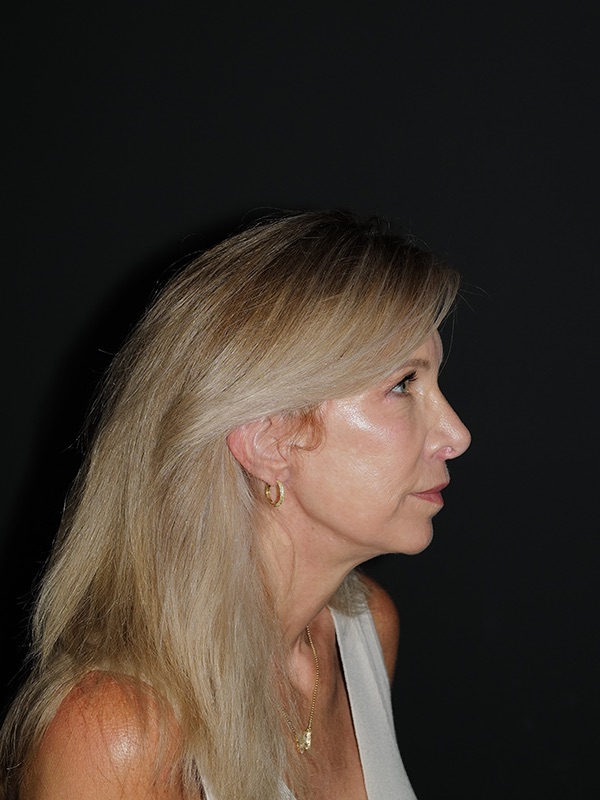 Facelift & Neck Lift Before & After Photo