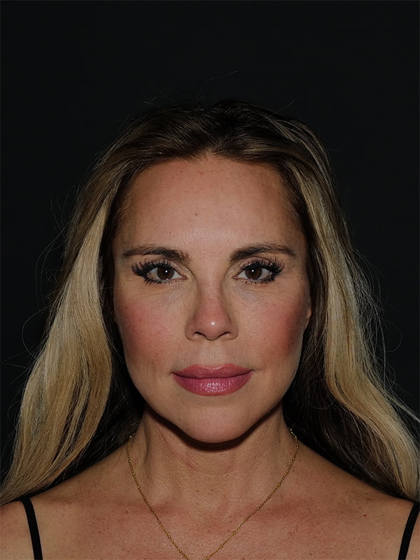 Facelift & Neck Lift Before & After Photo