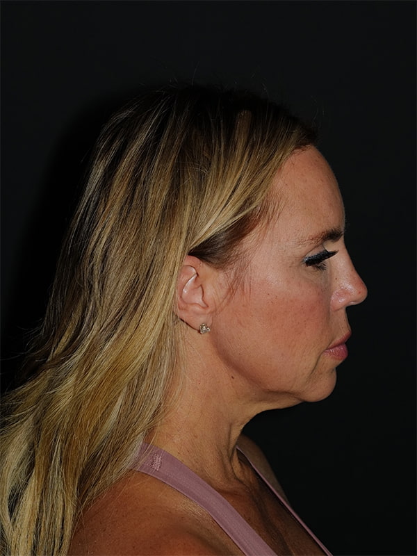 Facelift & Neck Lift Before & After Photo