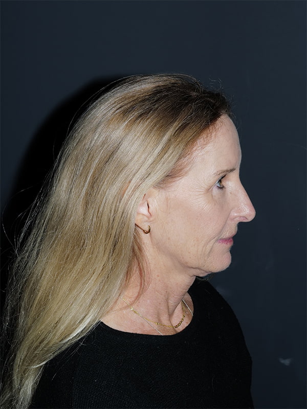 Facelift & Neck Lift Before & After Photo