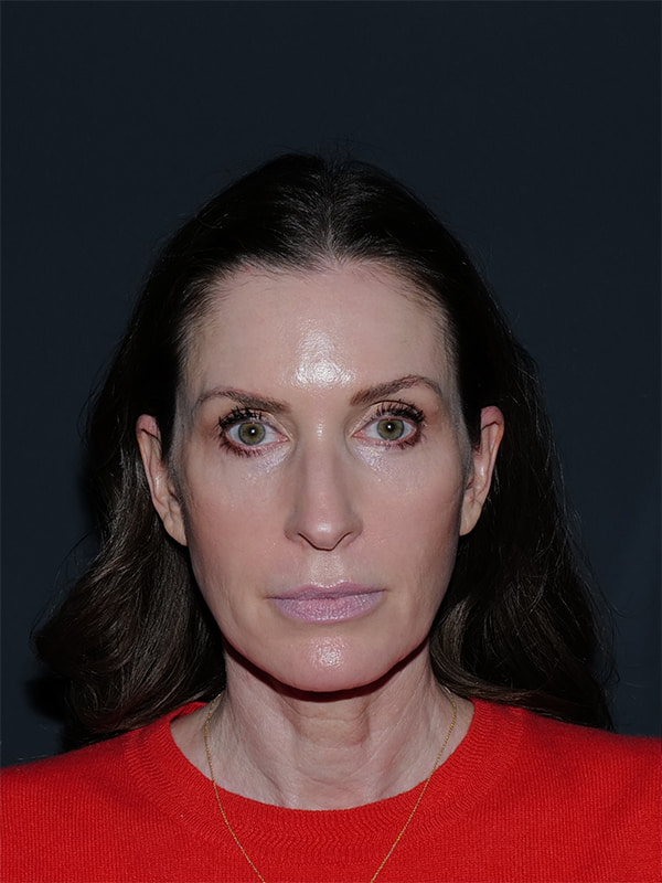 Facelift & Neck Lift Before & After Photo