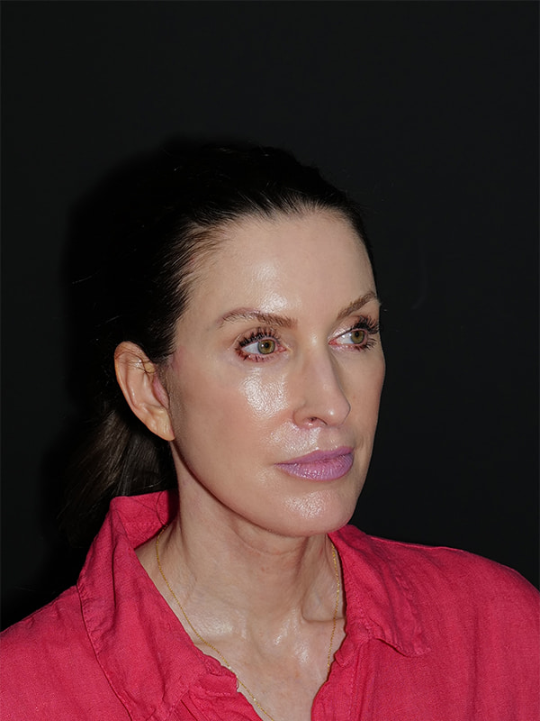 Facelift & Neck Lift Before & After Photo