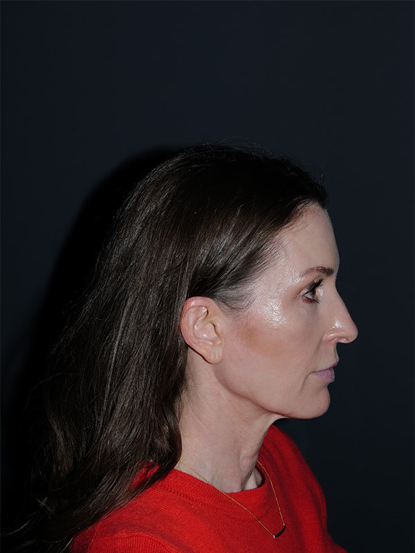 Facelift & Neck Lift Before & After Photo