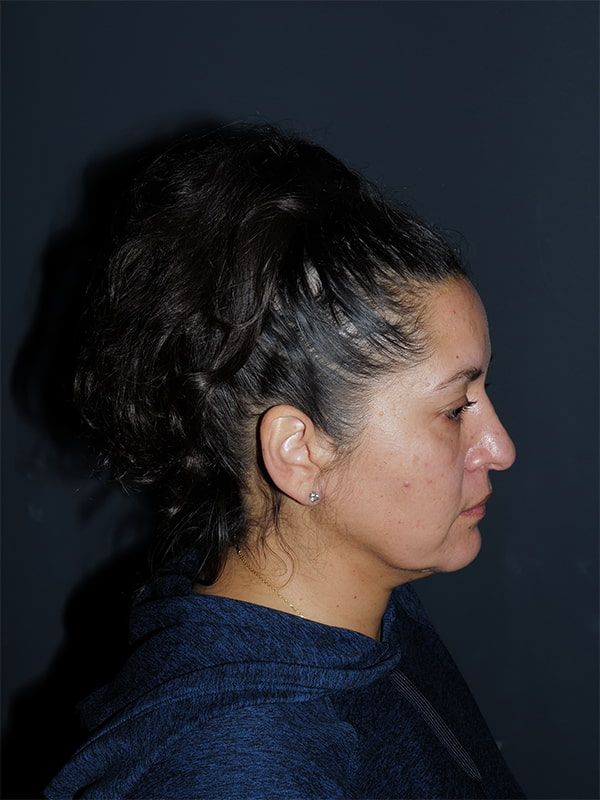 Facelift & Neck Lift Before & After Photo