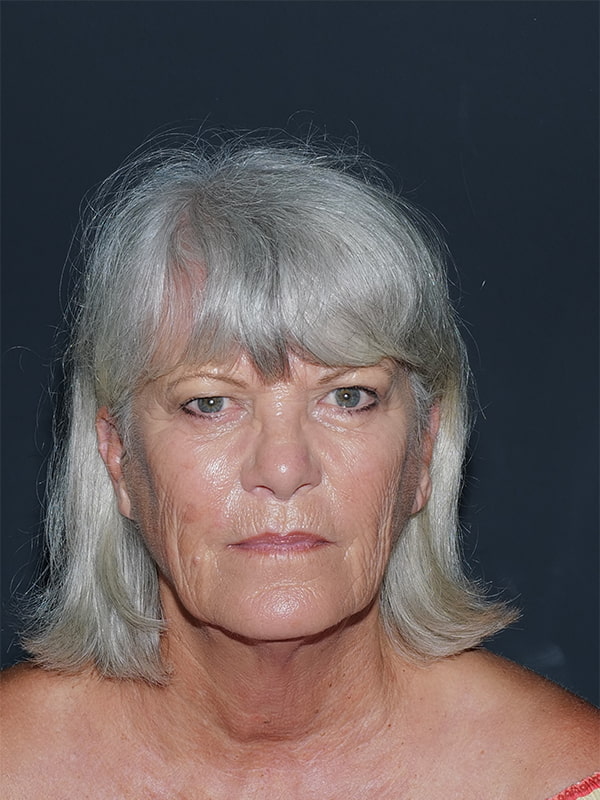 Facelift & Neck Lift Before & After Photo