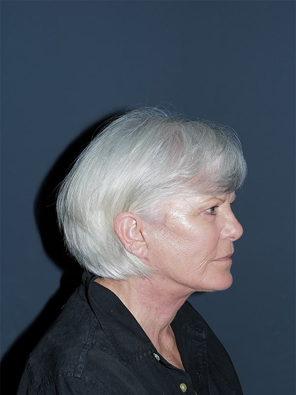 Facelift & Neck Lift Before & After Photo