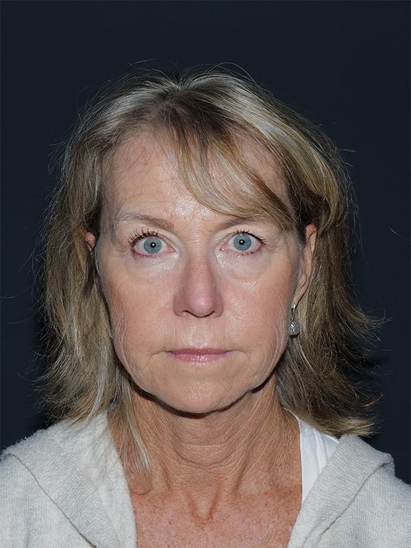 Facelift & Neck Lift Before & After Photo