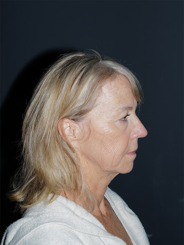 Facelift & Neck Lift Before & After Photo