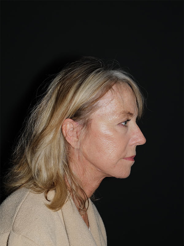 Facelift & Neck Lift Before & After Photo