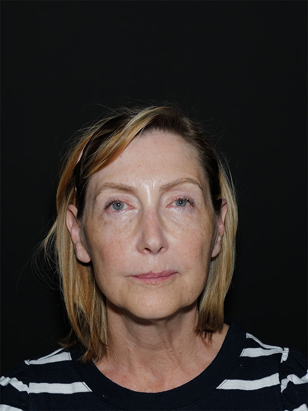 Facelift & Neck Lift Before & After Photo