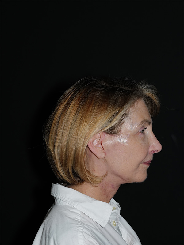 Facelift & Neck Lift Before & After Photo