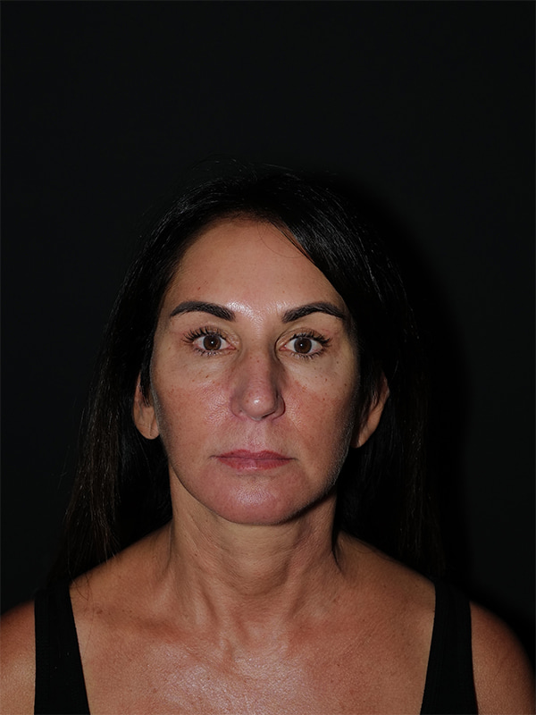 Facelift & Neck Lift Before & After Photo