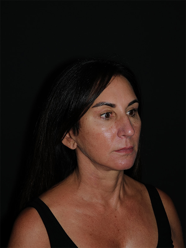 Facelift & Neck Lift Before & After Photo