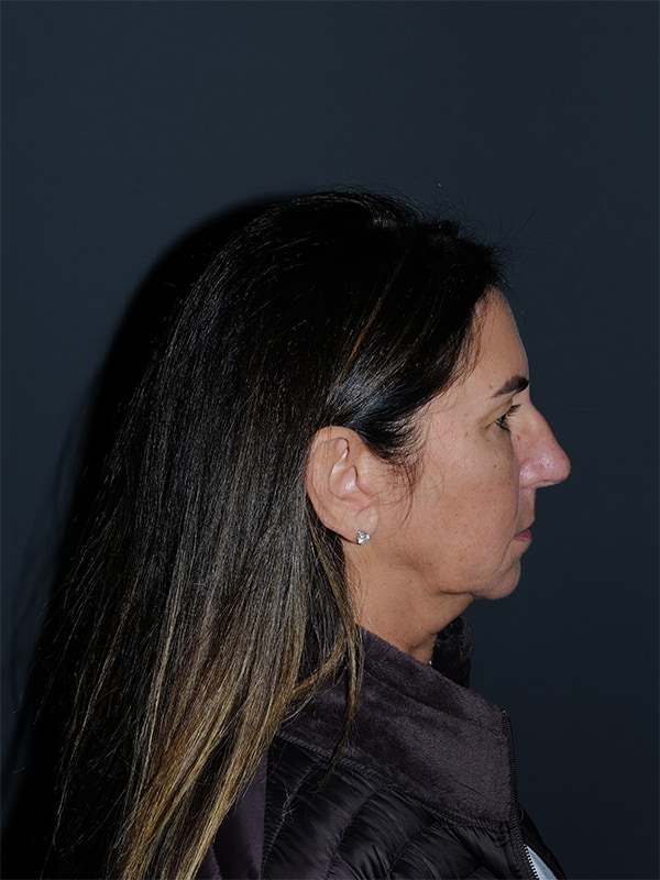 Facelift & Neck Lift Before & After Photo