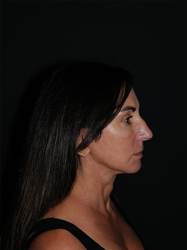 Facelift & Neck Lift Before & After Photo