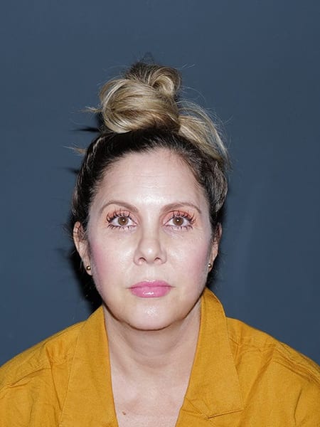 Facelift & Neck Lift Before & After Photo