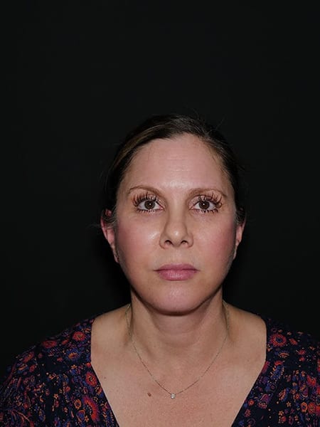 Facelift & Neck Lift Before & After Photo