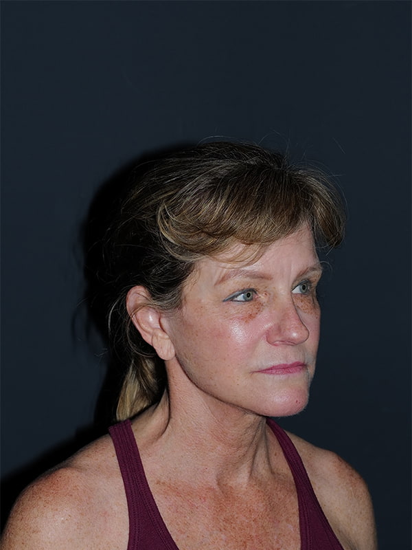 Facelift & Neck Lift Before & After Photo