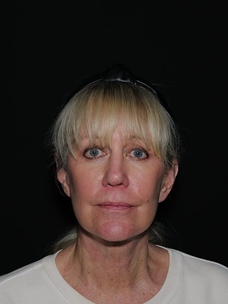 Facelift & Neck Lift Before & After Photo