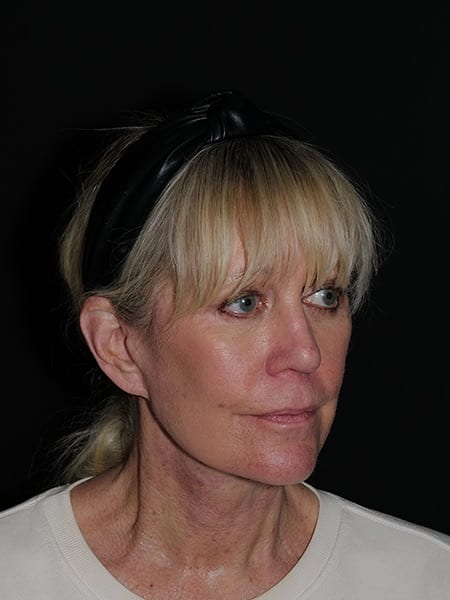 Facelift & Neck Lift Before & After Photo