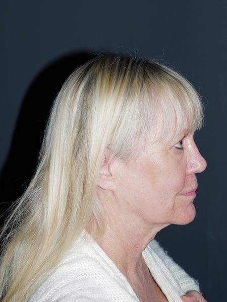 Facelift & Neck Lift Before & After Photo