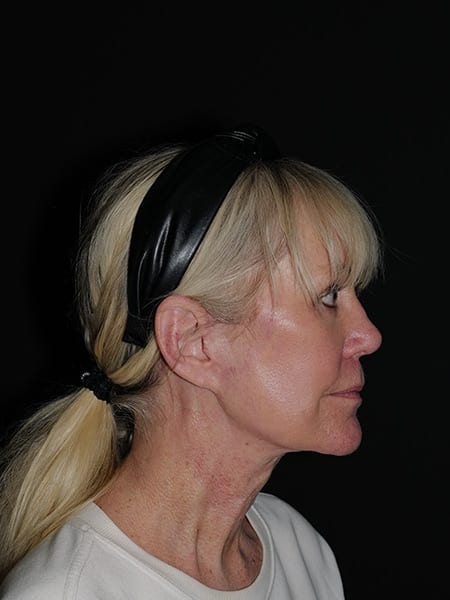 Facelift & Neck Lift Before & After Photo