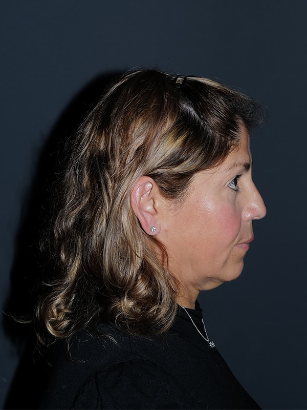 Facelift & Neck Lift Before & After Photo