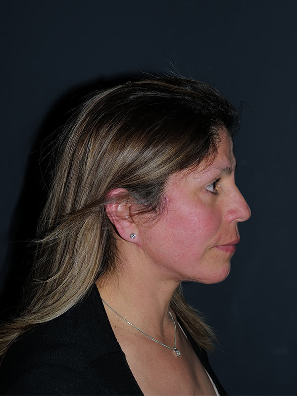 Facelift & Neck Lift Before & After Photo