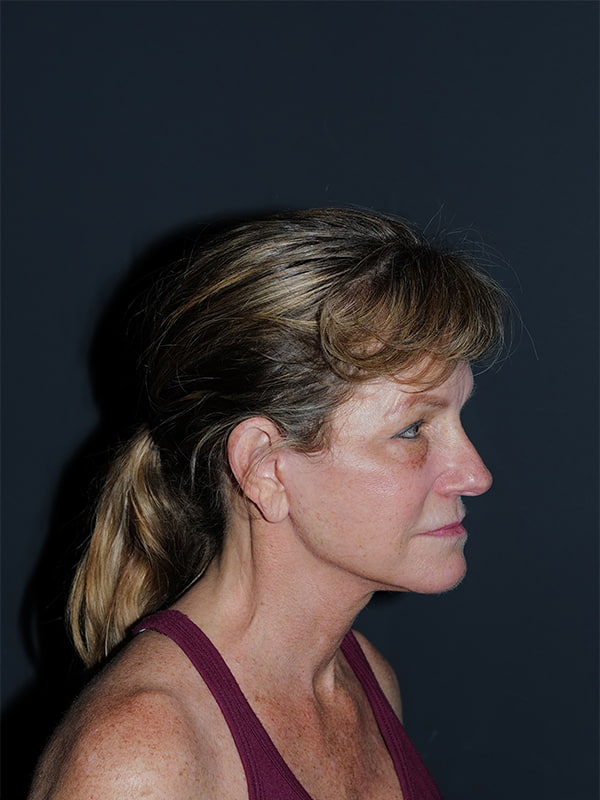 Facelift & Neck Lift Before & After Photo