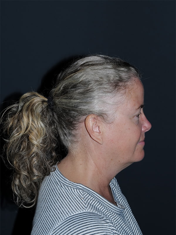 Facelift & Neck Lift Before & After Photo