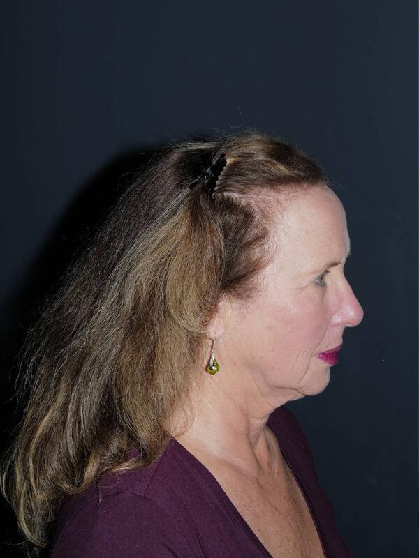 Facelift & Neck Lift Before & After Photo