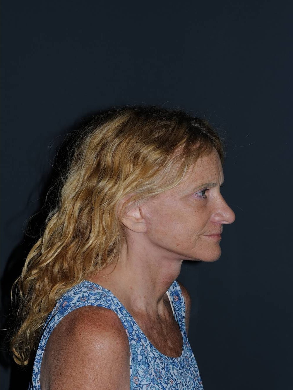 Facelift & Neck Lift Before & After Photo