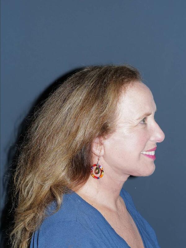 Facelift & Neck Lift Before & After Photo