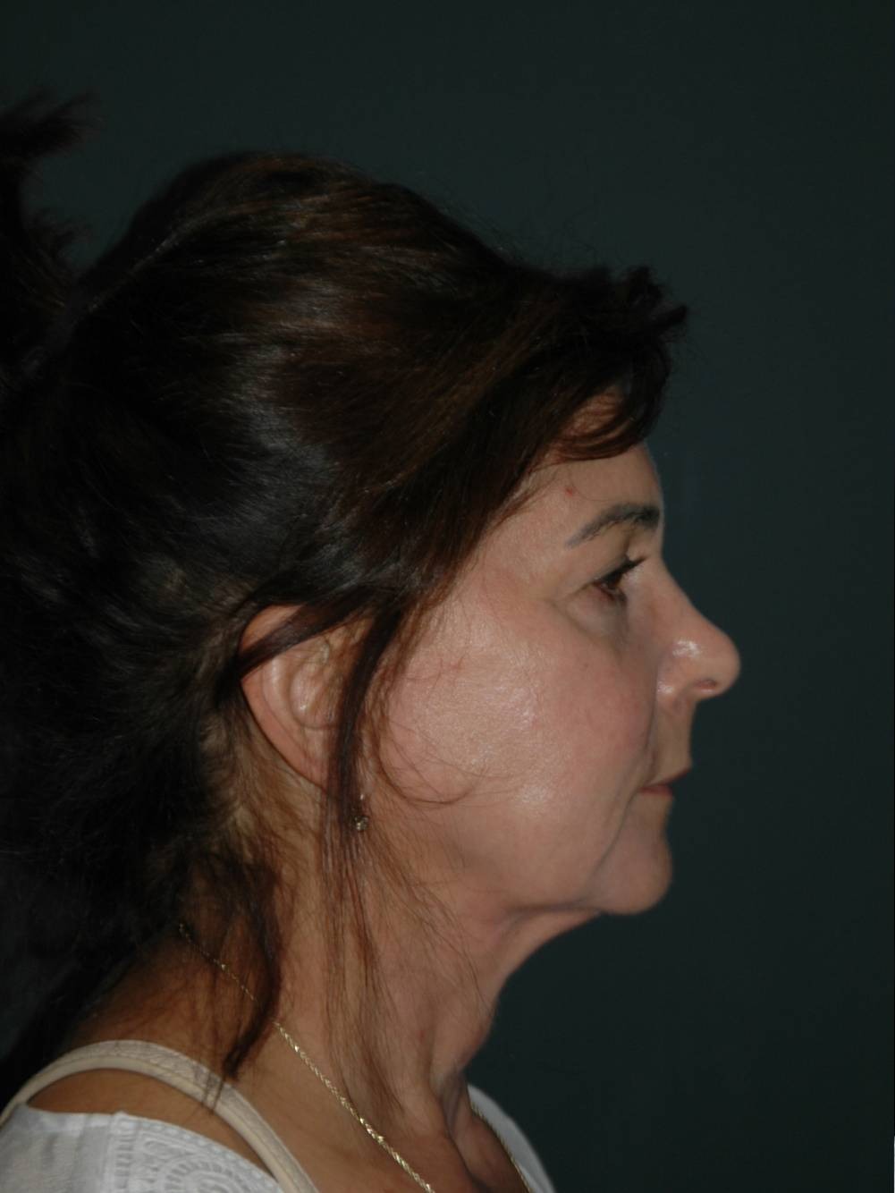 Facelift & Neck Lift Before & After Photo