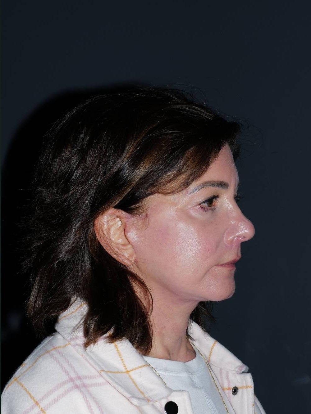 Facelift & Neck Lift Before & After Photo