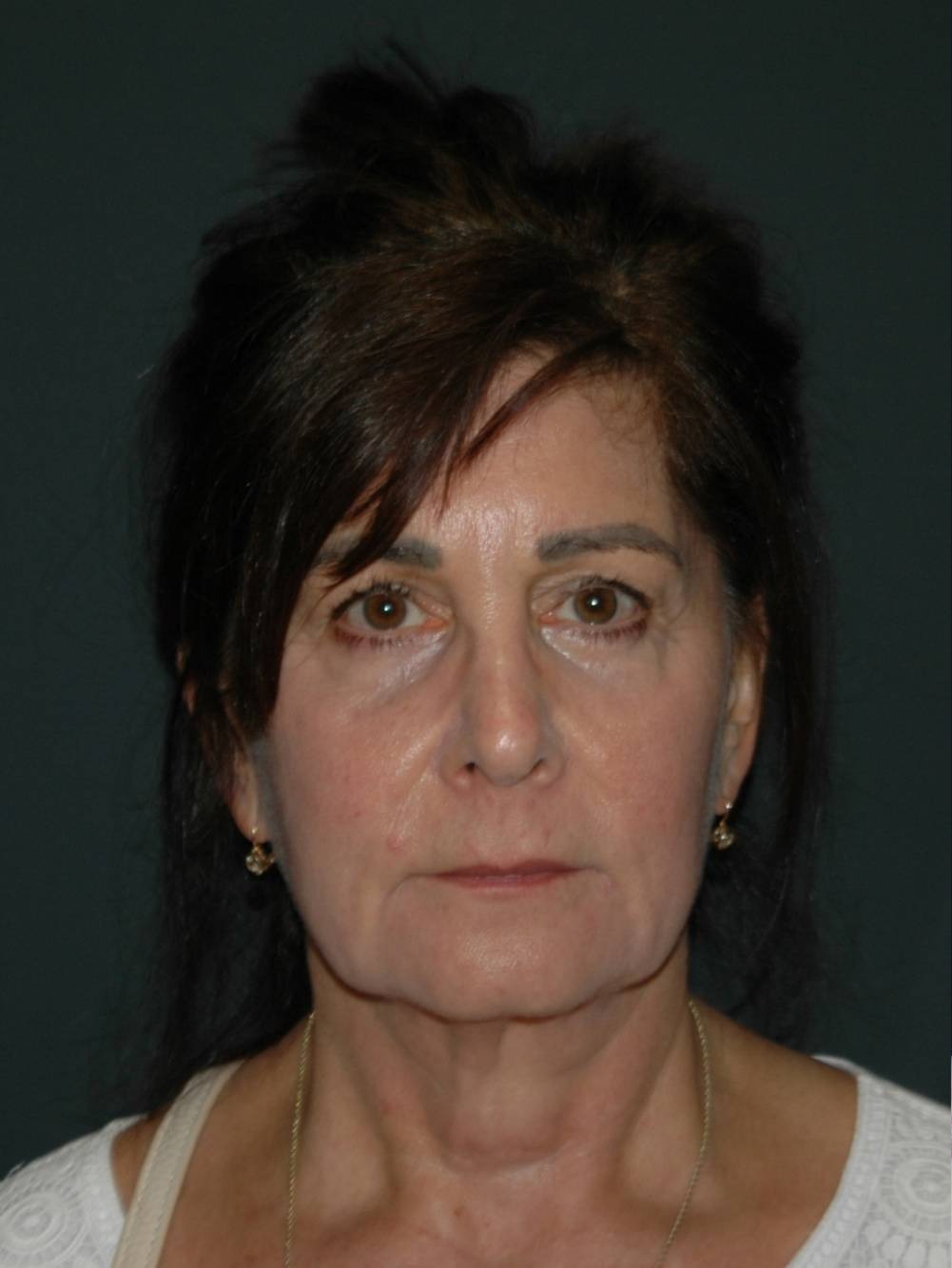 Facelift & Neck Lift Before & After Photo