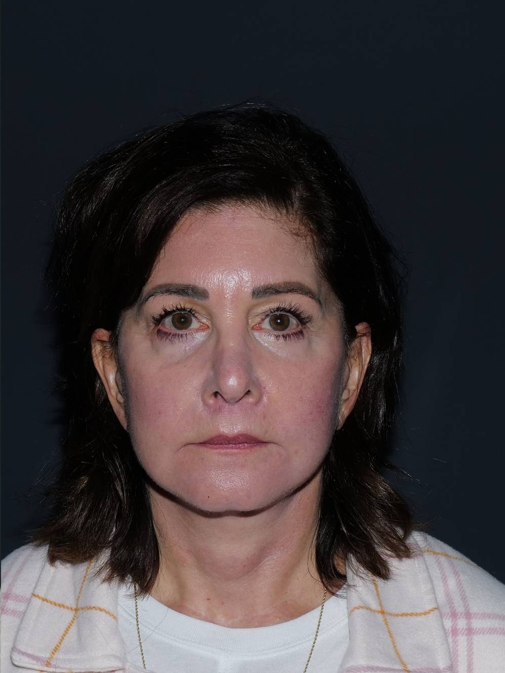 Facelift & Neck Lift Before & After Photo