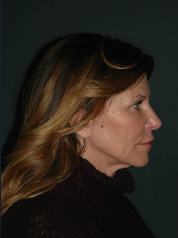 Facelift & Neck Lift Before & After Photo