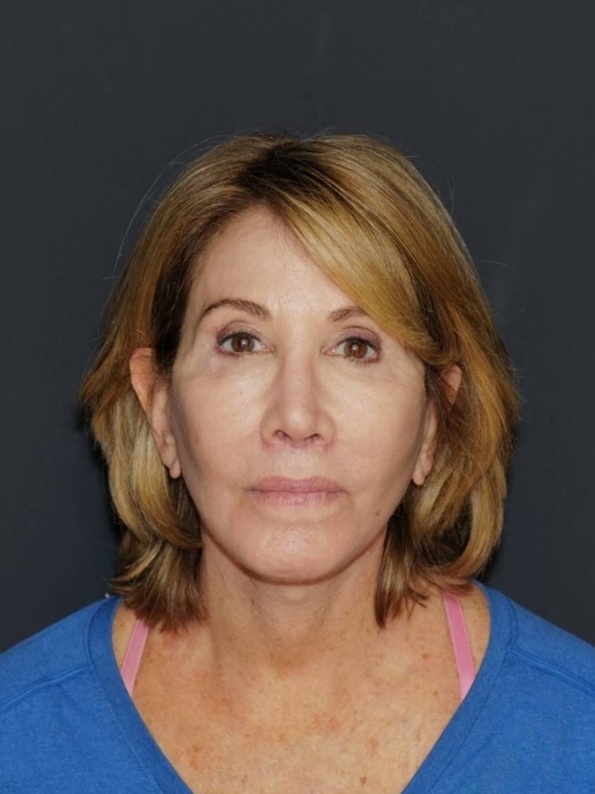 Facelift & Neck Lift Before & After Photo