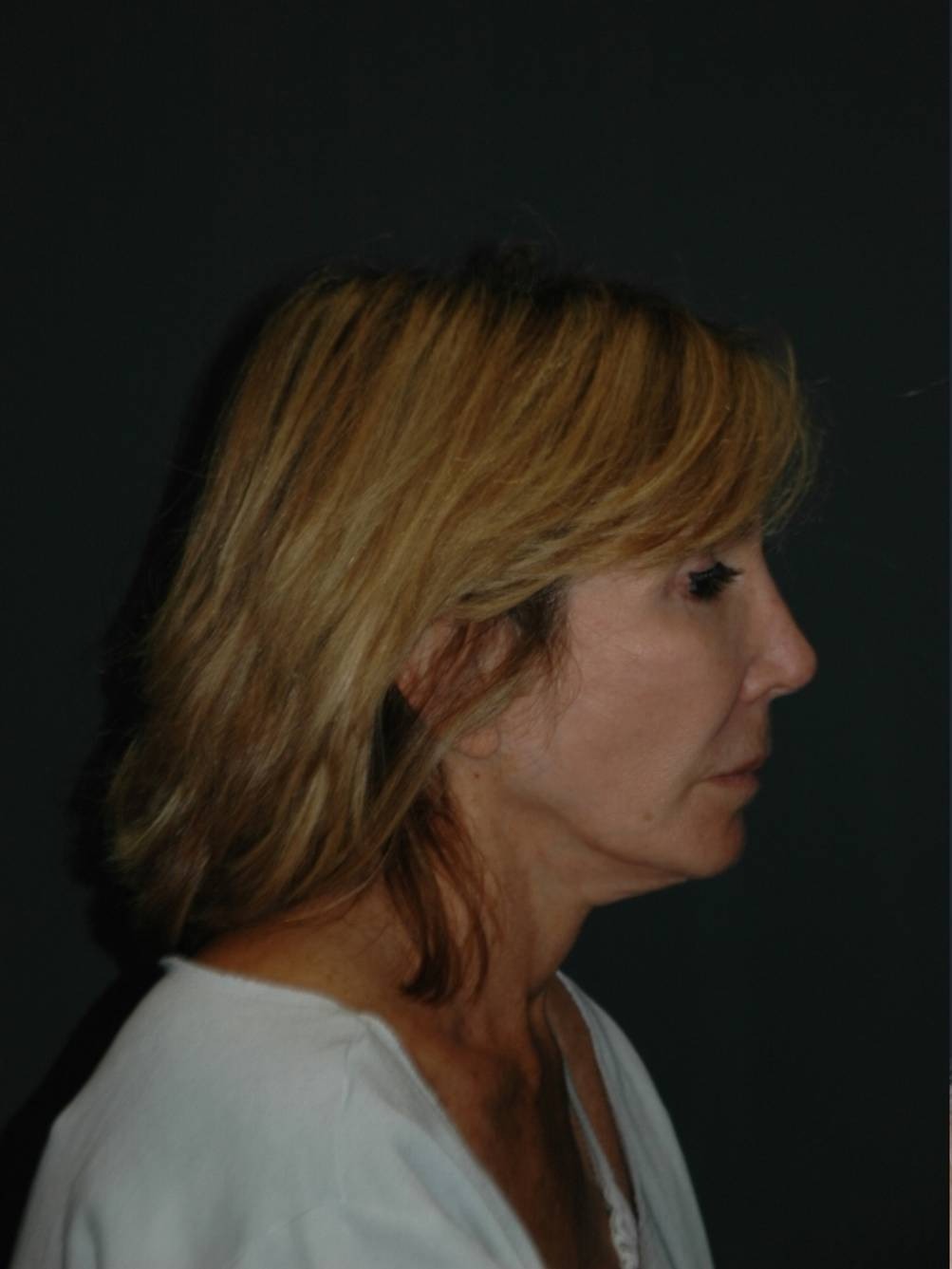 Facelift & Neck Lift Before & After Photo