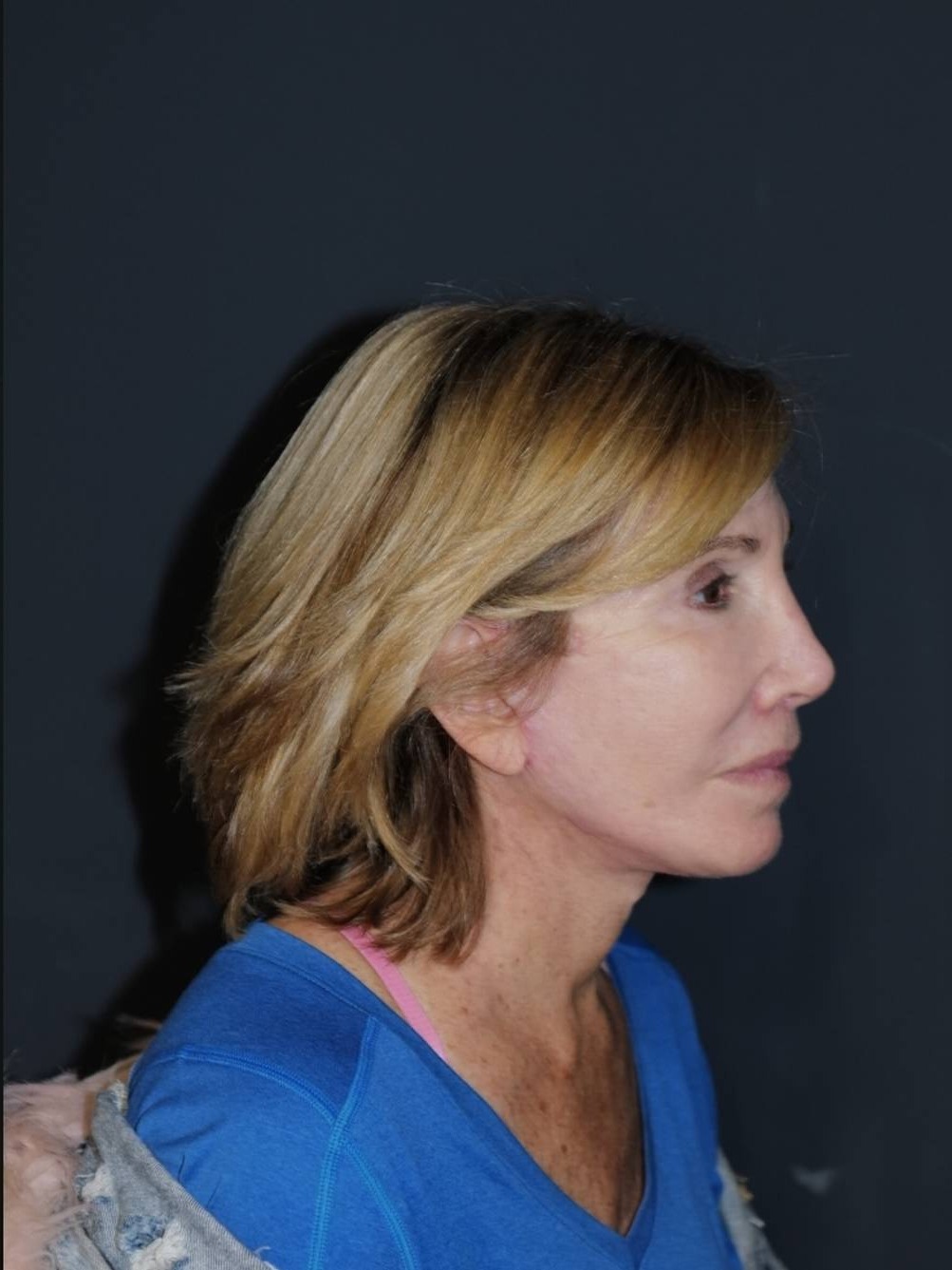 Facelift & Neck Lift Before & After Photo