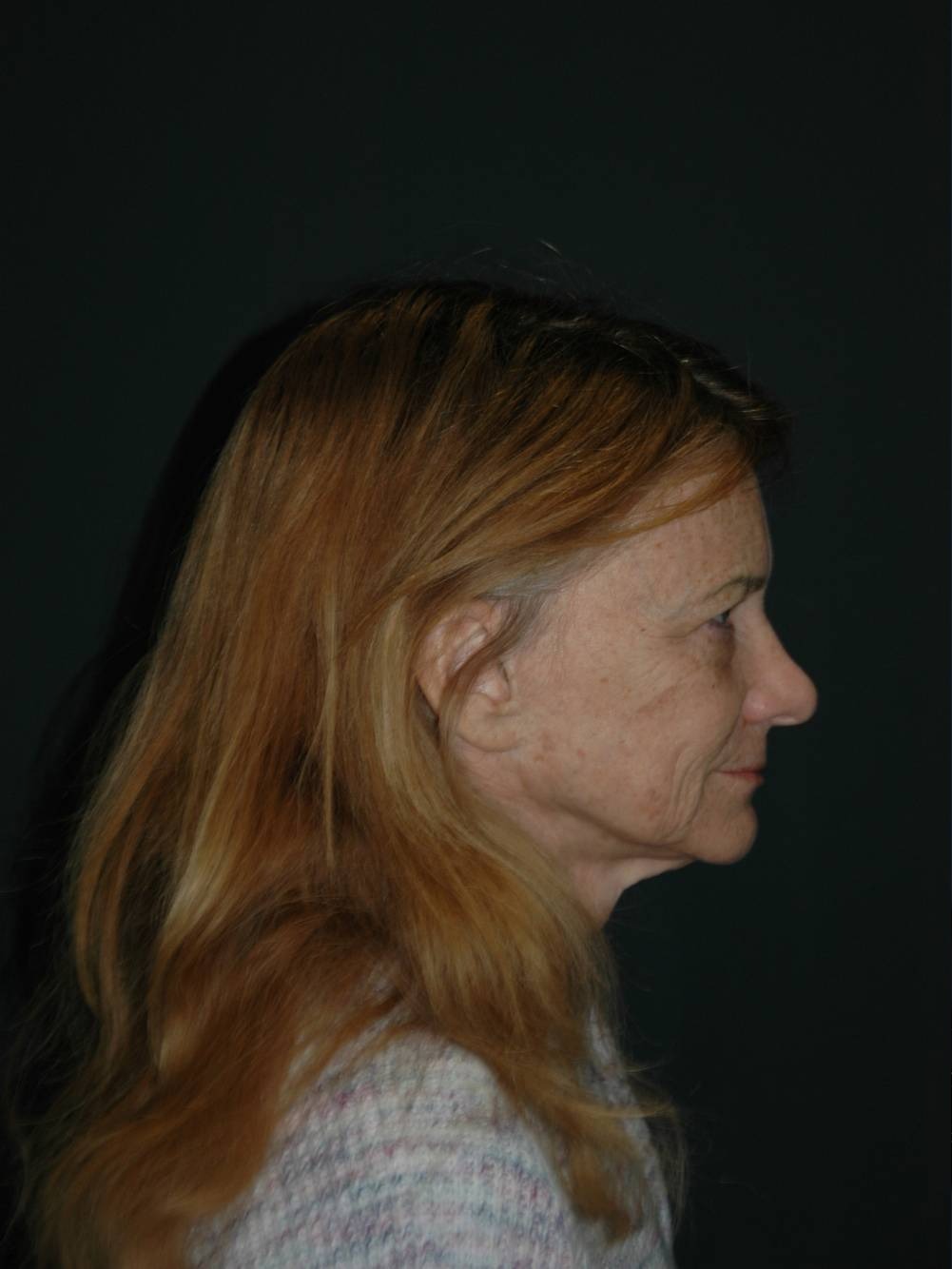 Facelift & Neck Lift Before & After Photo